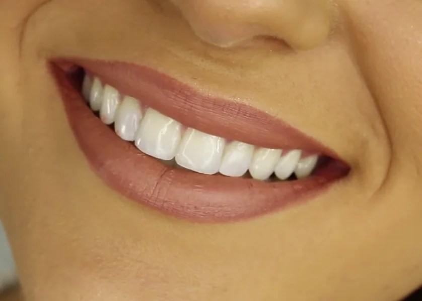 Can teeth whitening damage Enamel? Dental