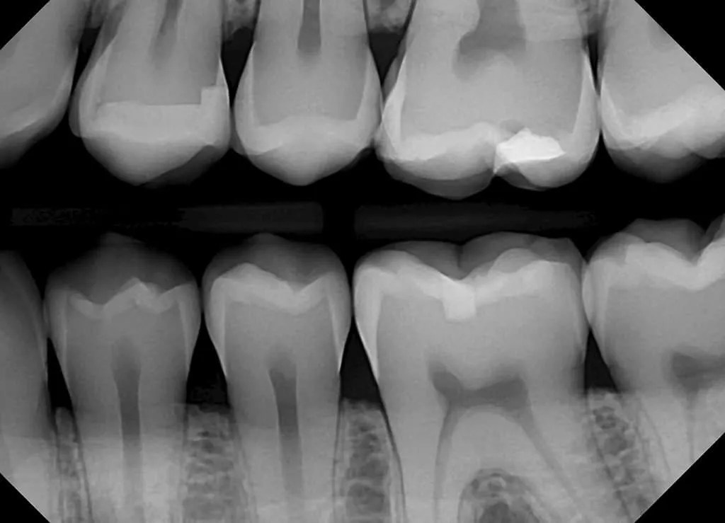 How Do XRays See Inside Your Mouth? MyDental Tampa