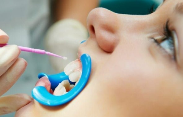 5 Fakta yang harus diketahui tentang sealant gigi