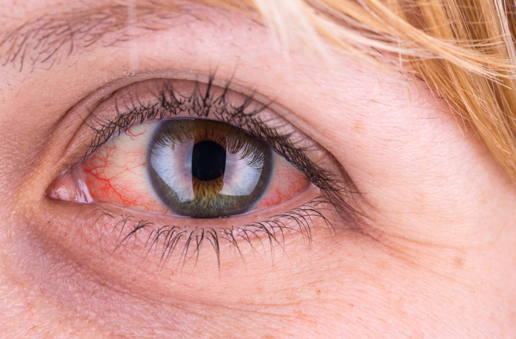 Can Dry Eye Damage Your Vision?
