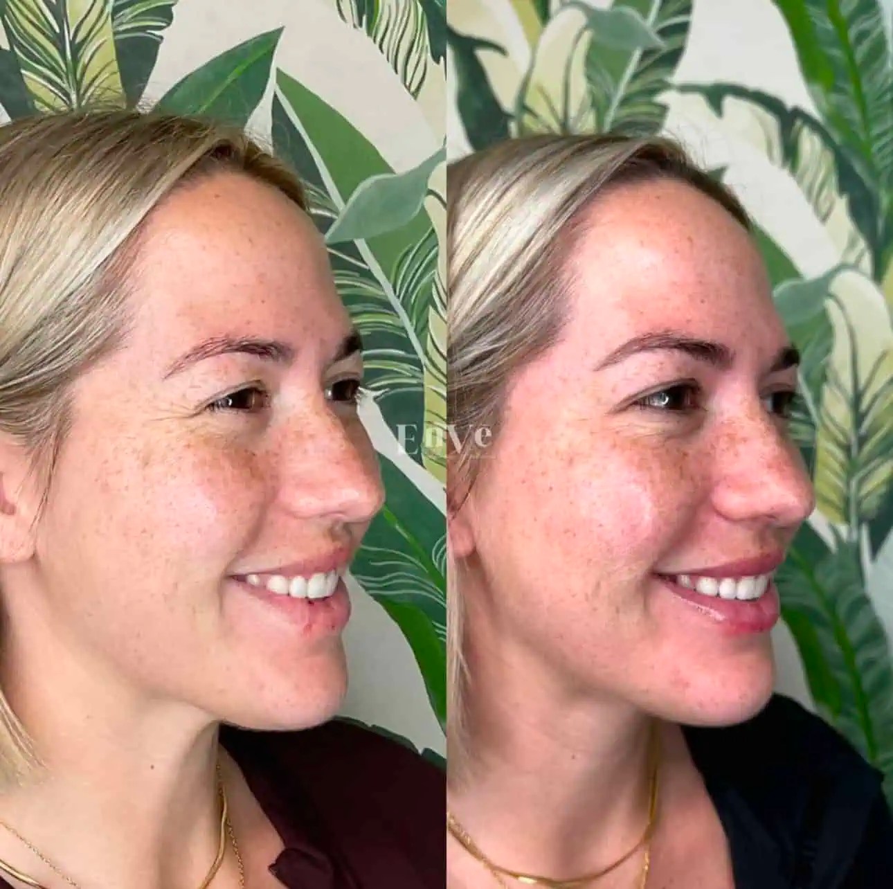 Botox Before And After Enve California Aesthetics(03)