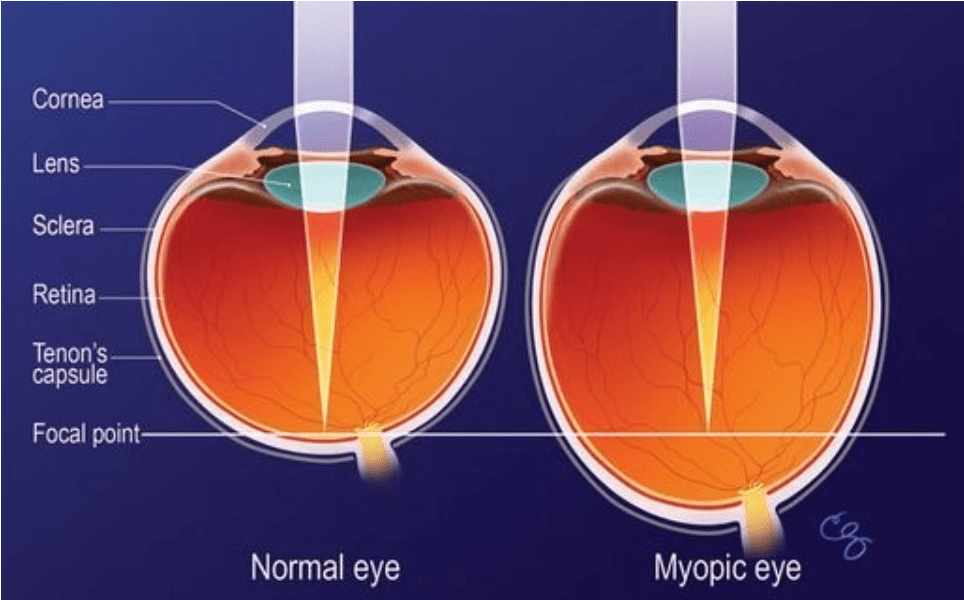 Myopia Management & Pediatric My Eye Room
