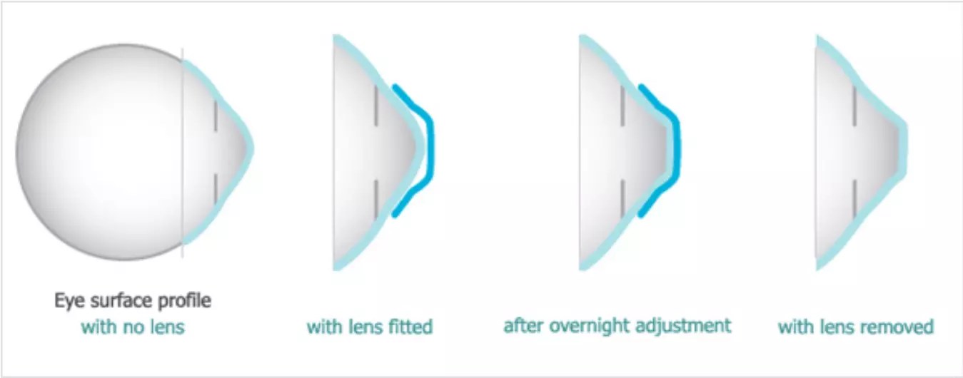 Understanding OrthoK NonSurgical Alternative to Correcting Vision