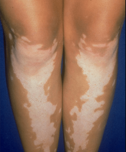 What's Causing White Spots On Legs And How Can I Treat Them? -Storytimes