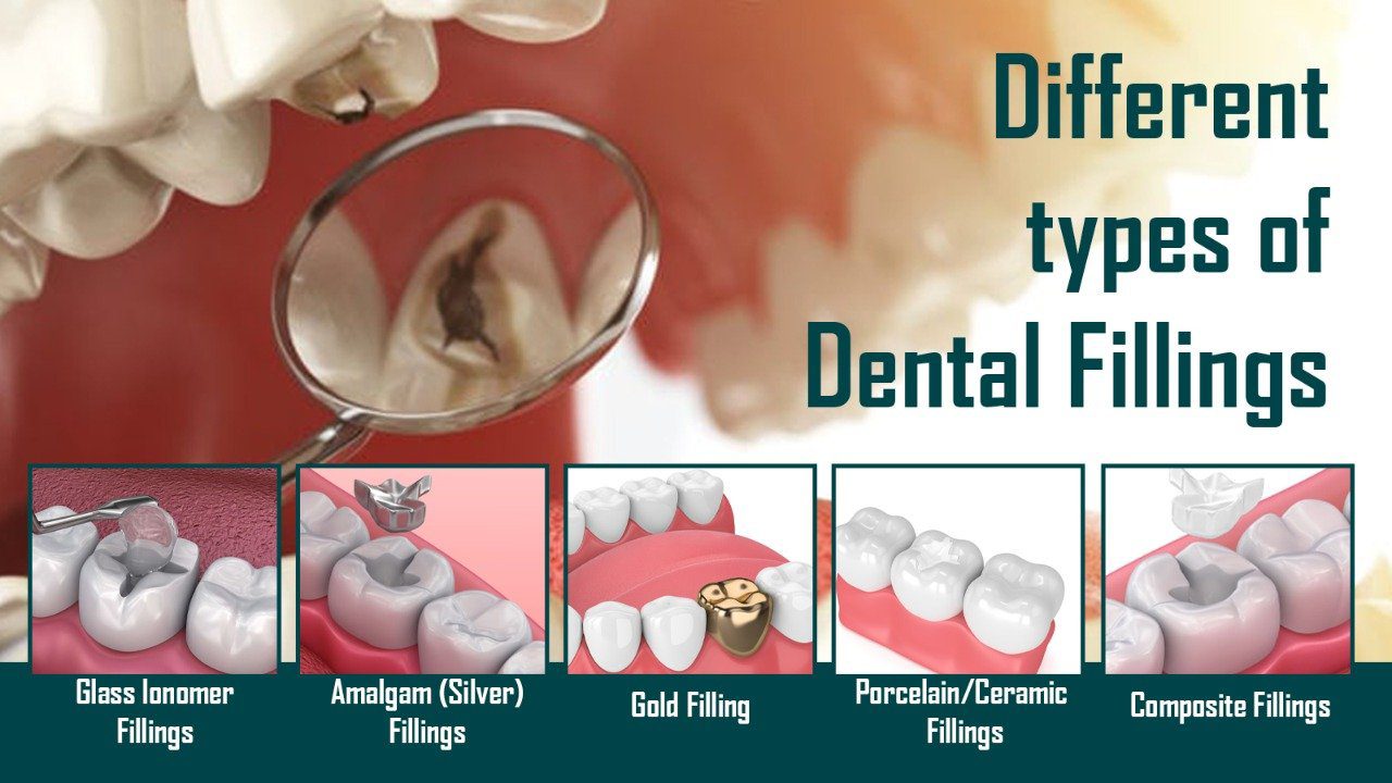 What are the Different Types of Dental Fillings? My Gentle Dentist