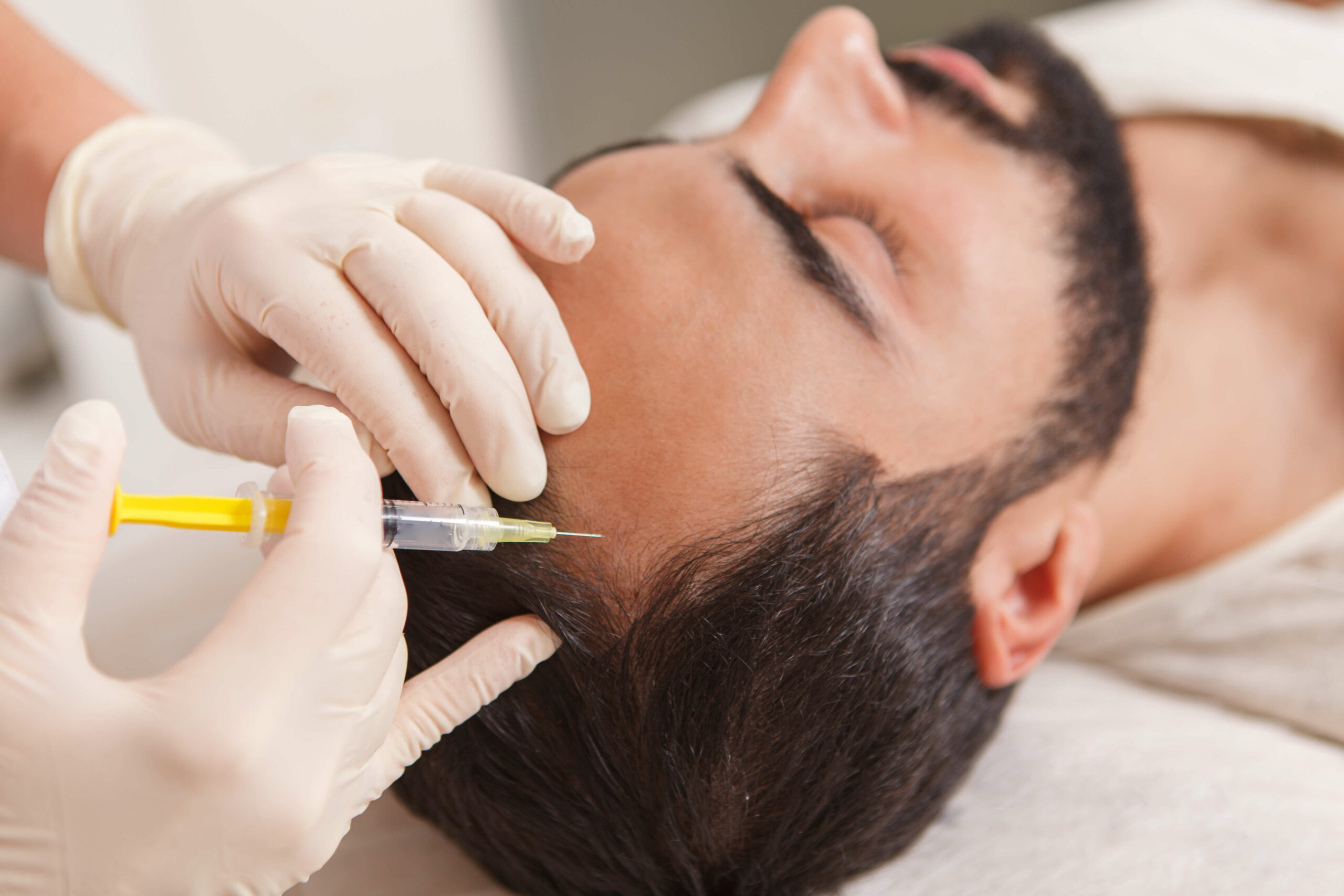 Microneedling for hair loss myhair