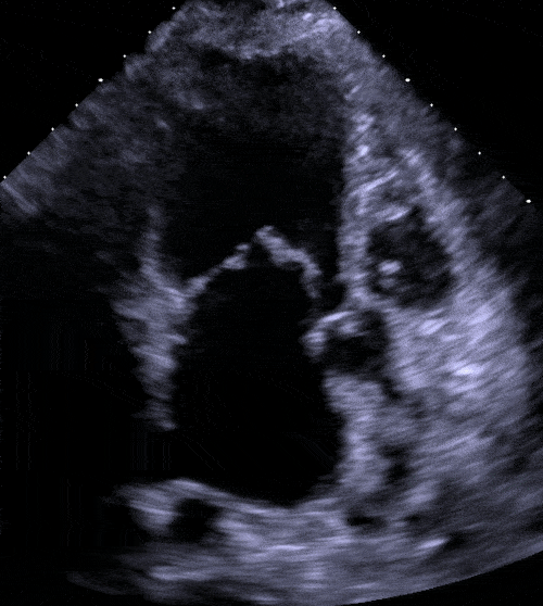 Mitral Stenosis A Tight Mitral Valve • MyHeart