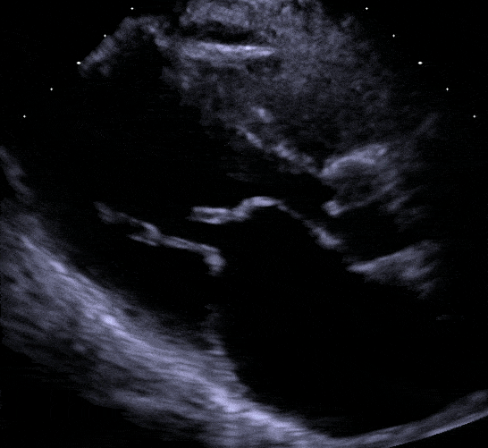 Mitral Stenosis A Tight Mitral Valve