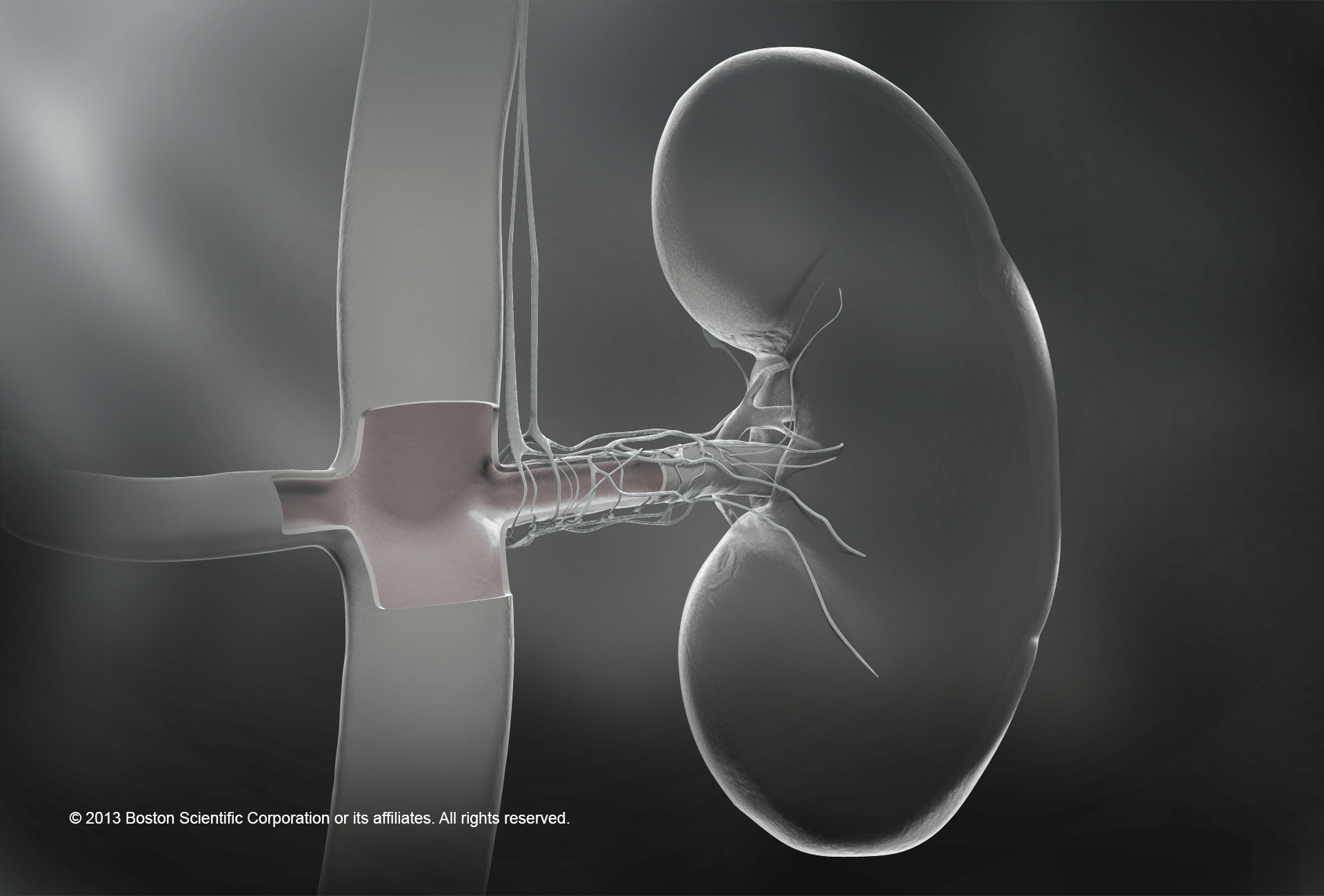 Treatment of High Blood Pressure When Medicines Don't Work • MyHeart
