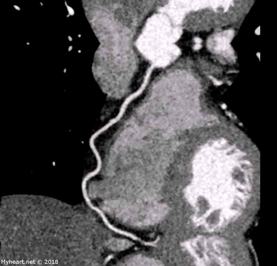 Heart Ct Scan Vs Angiogram ct scan machine