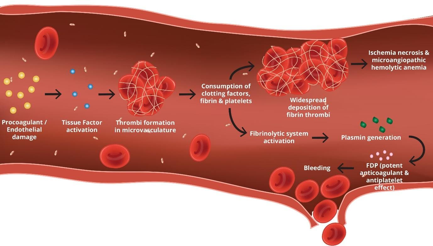 Disseminated Intravascular Coagulation (DIC) Symptoms & Causes