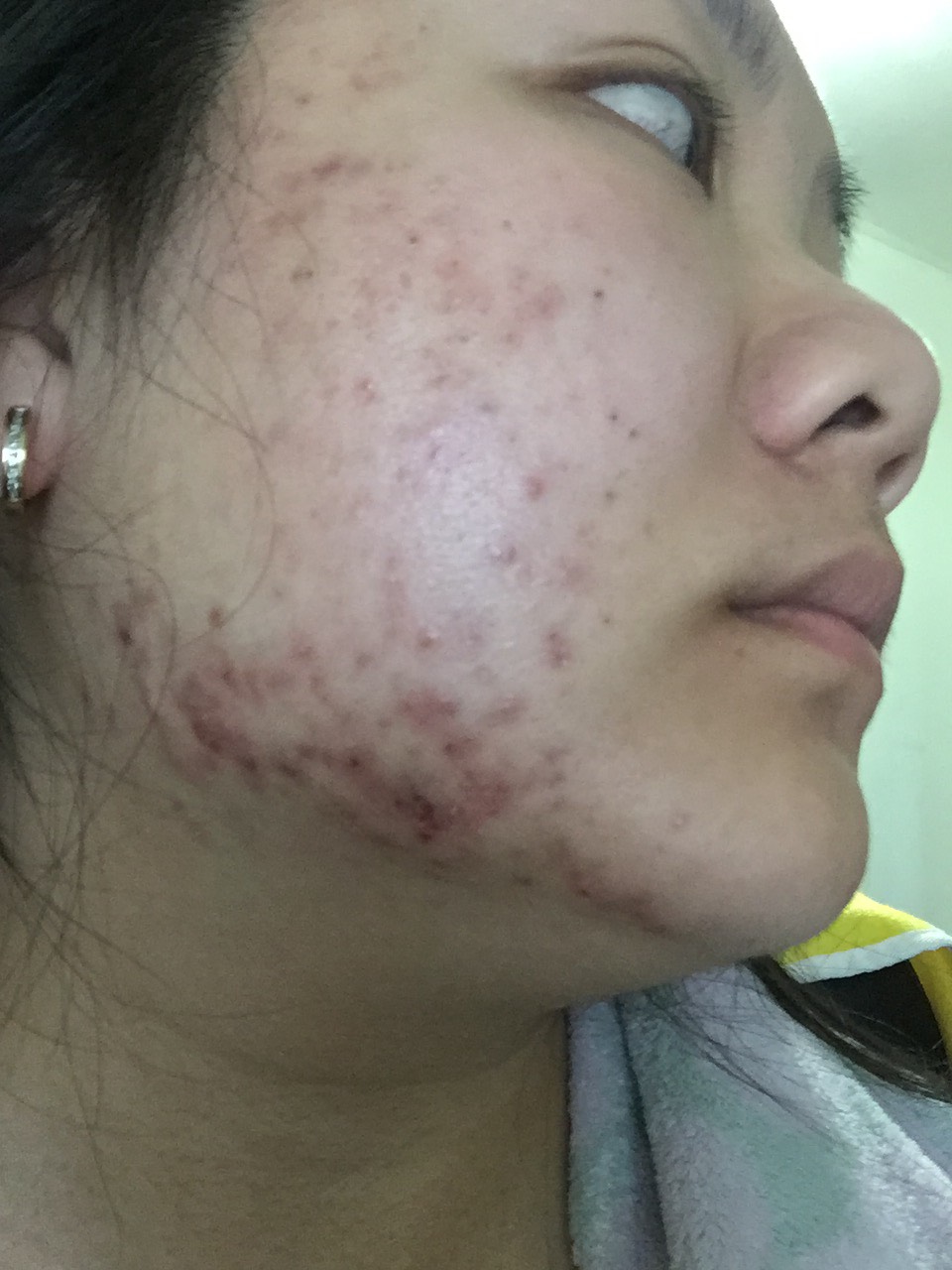 10 STEP KOREAN SKIN CARE ROUTINE FOR ACNE PRONE SKIN myHUBS