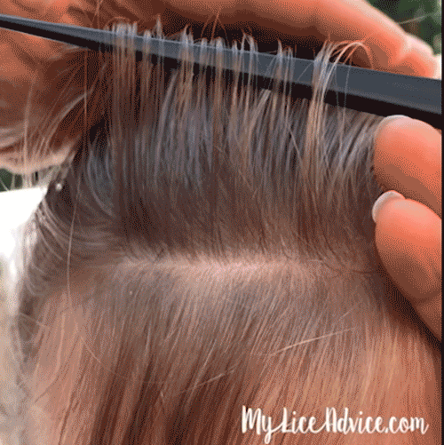 How to Check Your Child's Head for Lice Simple Steps with Pictures