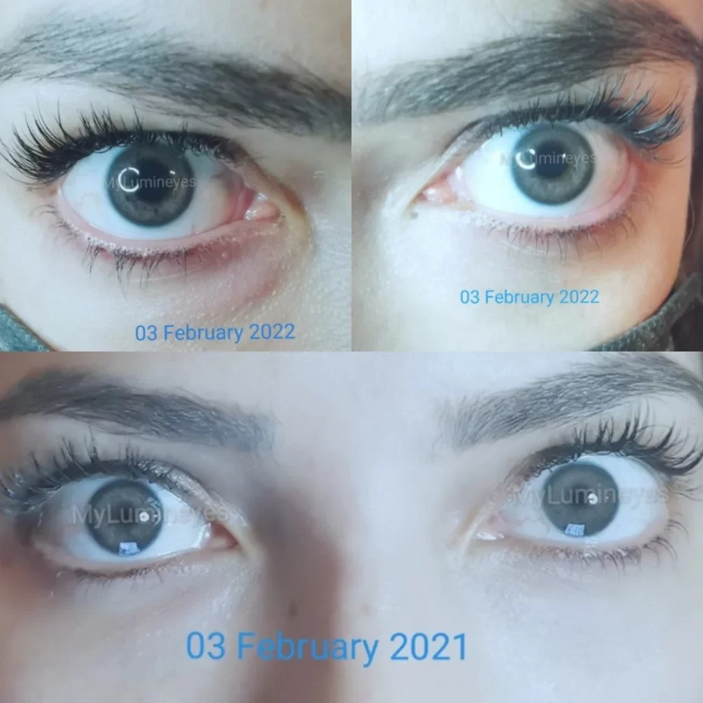Laser Eye Color Change Before And After