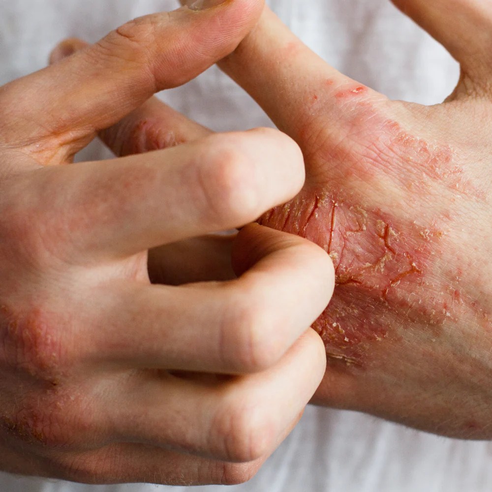 Finally! A Natural Eczema Treatment That Works MyMagicHealer
