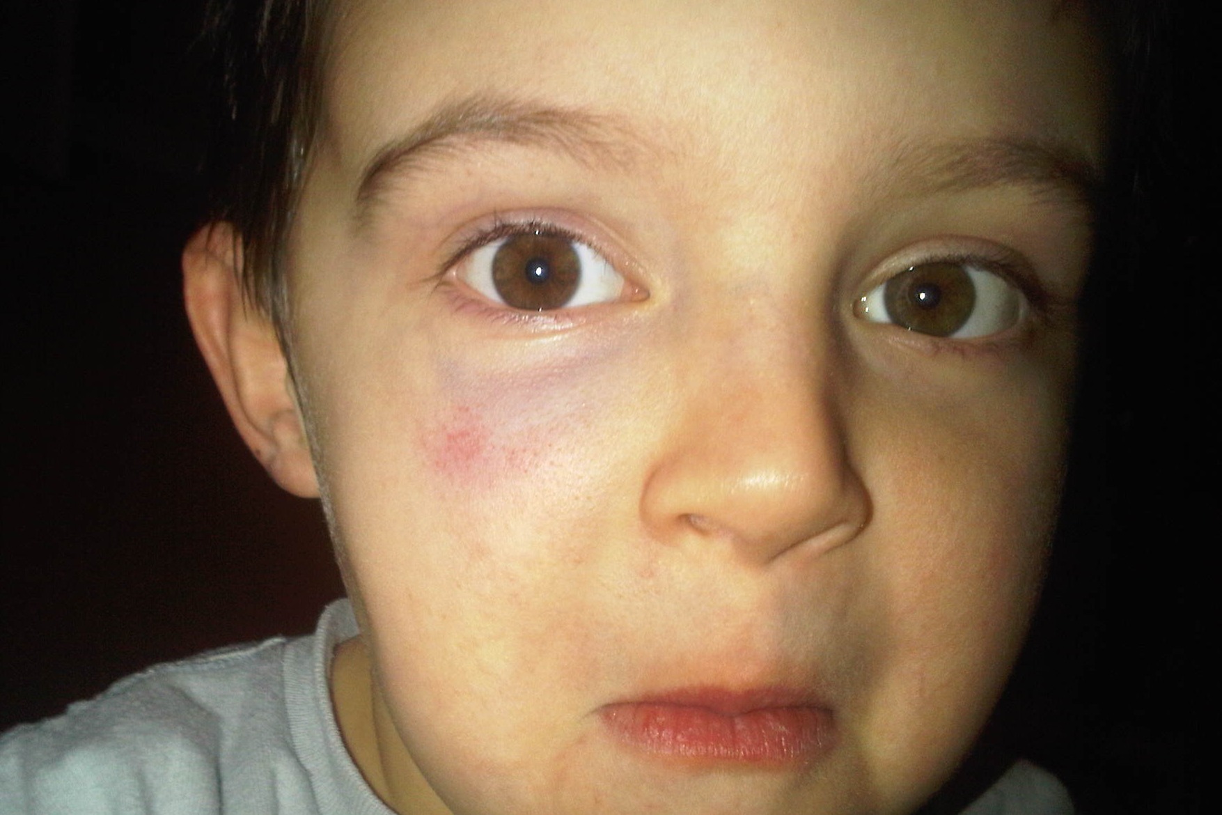 Black Eye Bing images