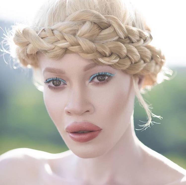 Stunning Model with Albinism Expands the Definition of Beauty