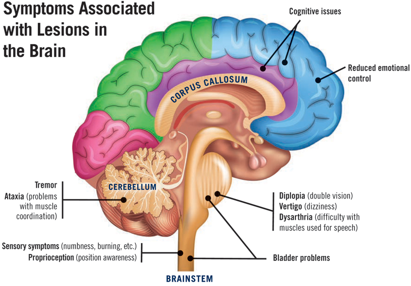 Cervical Mri Bright Spot at Back of Skull Loar Theight