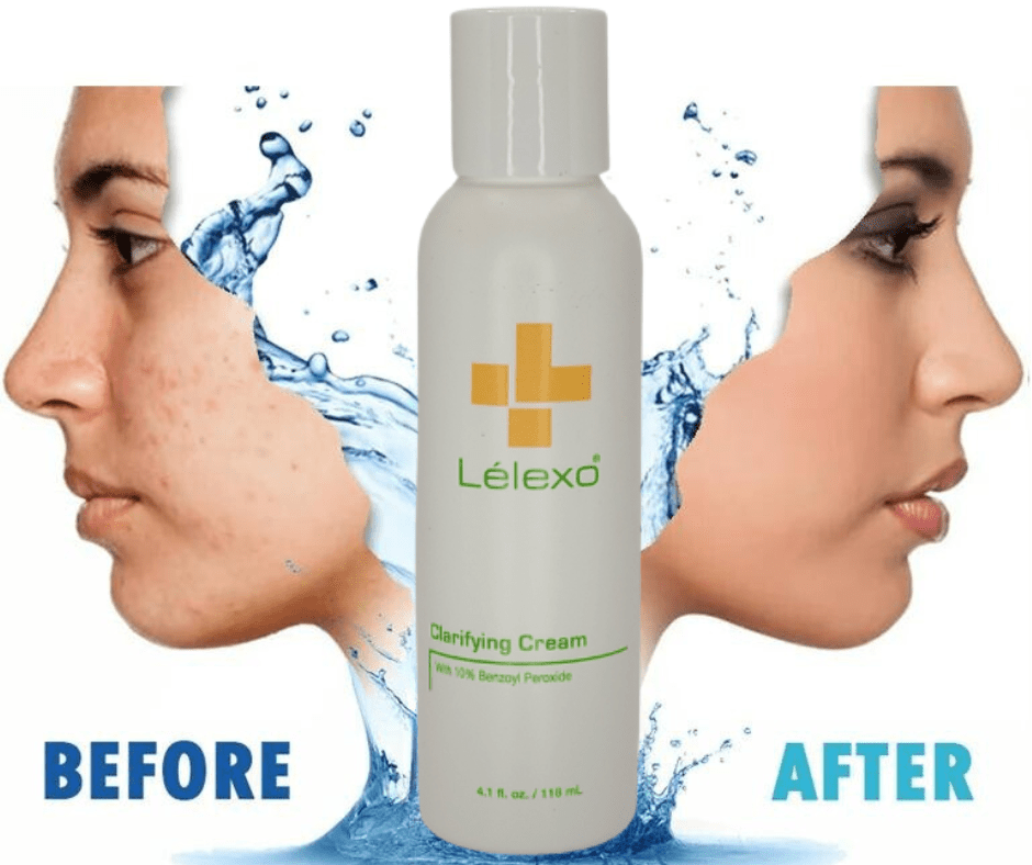 What is Benzoyl Peroxide in Our Skincare Products? Next Level