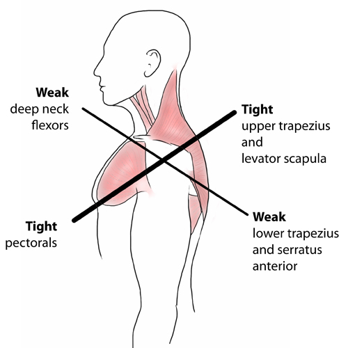 Upper cross syndrome Symptoms, Causes & Treatment