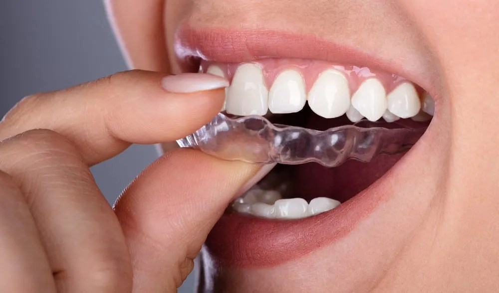 How Long Does It Take for Invisalign to Straighten Your Teeth
