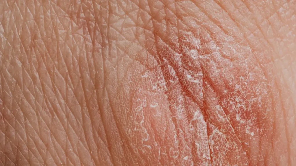 Does Hard Water Cause Dry Skin? Myotone