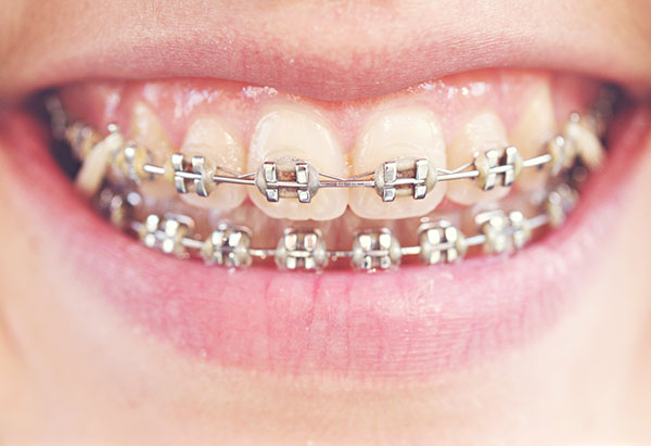 Advanced Options for Medicaid Braces in Illinois - My Primary Dental