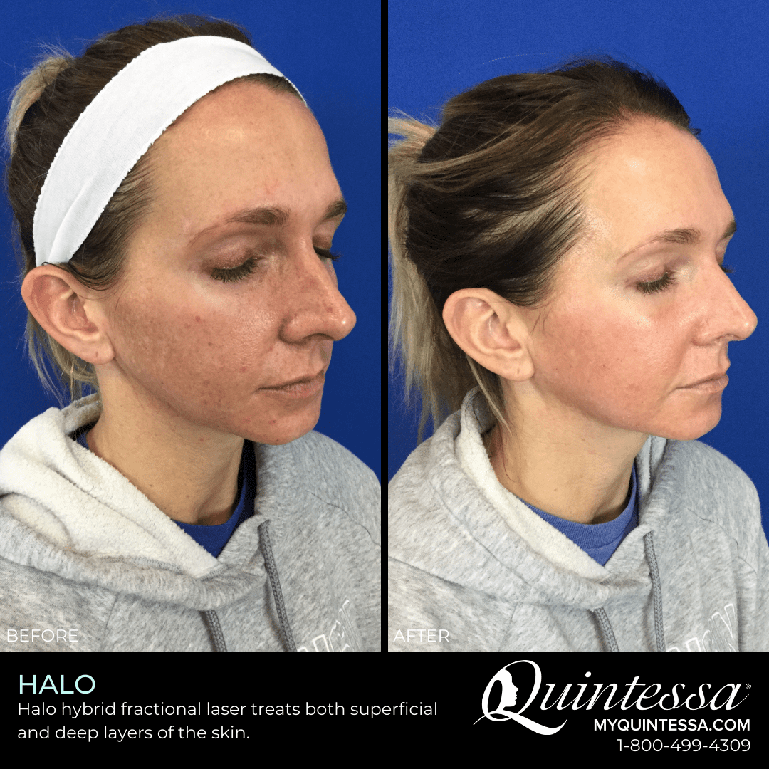 Halo Laser Treatment Milwaukee & Madison Quintessa
