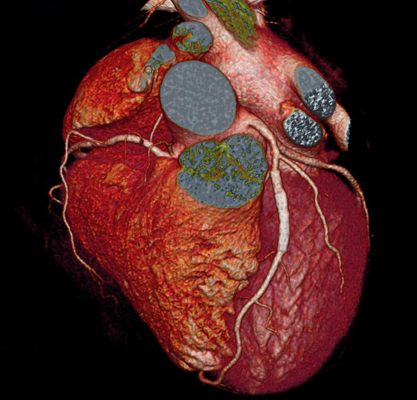 Shore Imaging – Mri, Ct, X-Ray, & Women's Imaging Center, Lakewood, Whiting, New Jersey » Coronary Cta