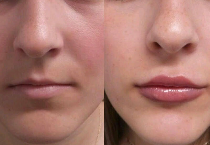 Lip Fillers Bradford MySkyn
