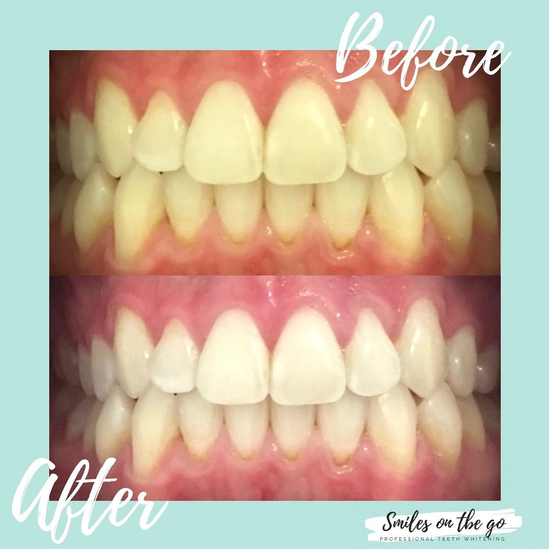 Teeth Whitening | Smiles On The Go