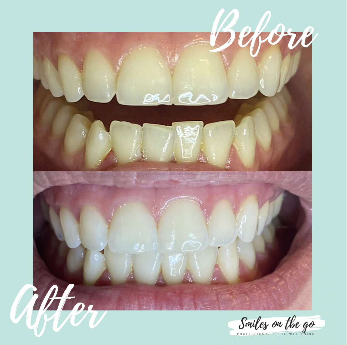 Teeth Whitening Smiles On The Go