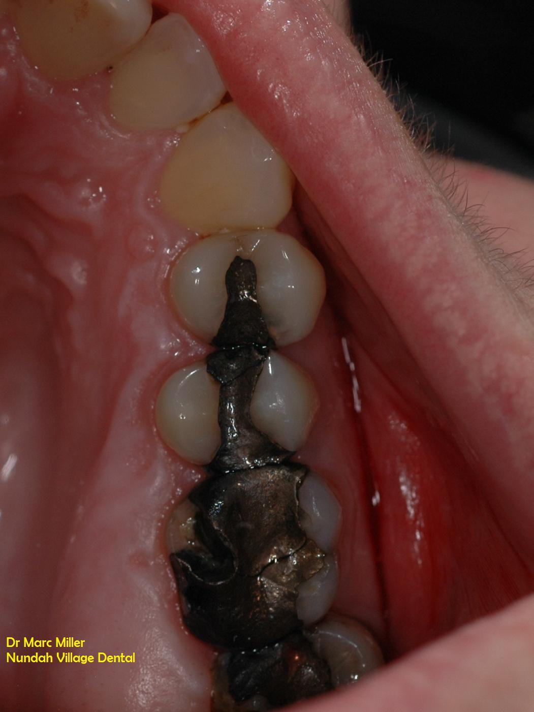 cracked teeth Nundah Village Dental