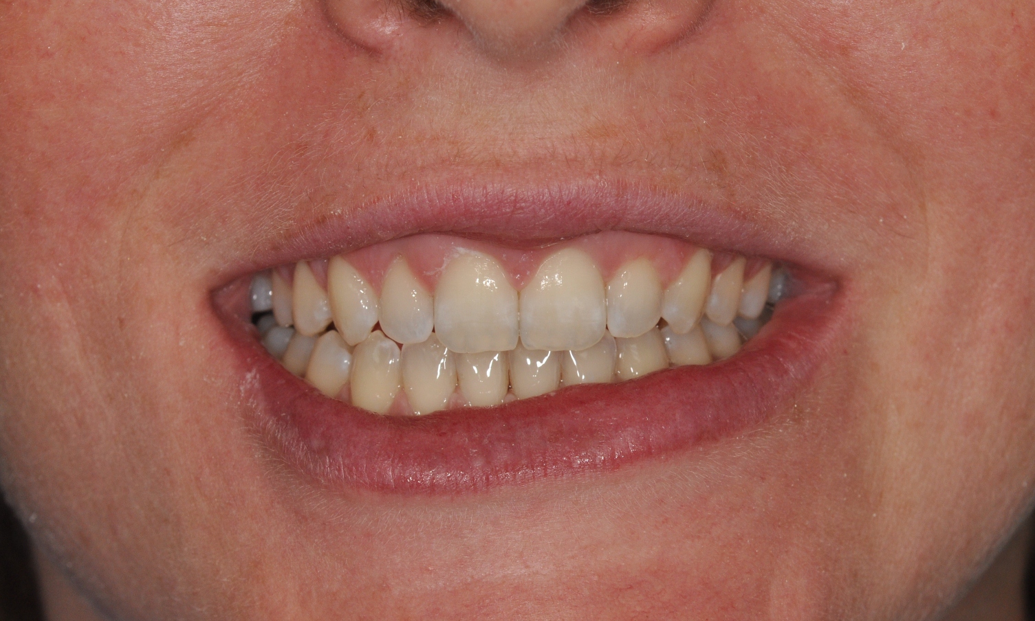 front teeth Nundah Village Dental