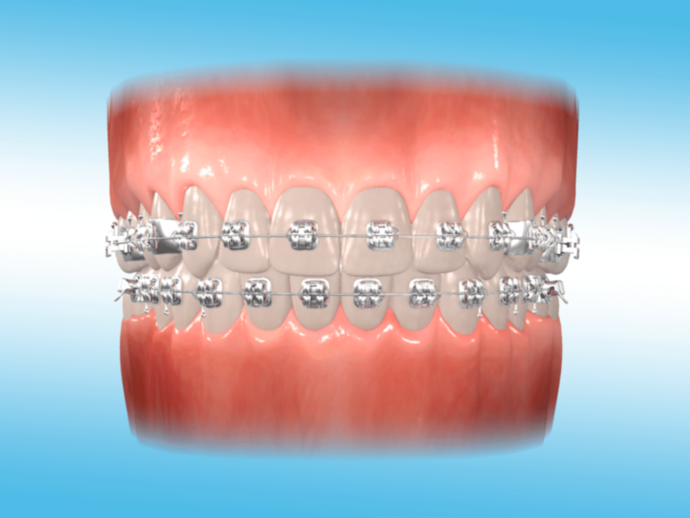 Orthodontic Appliances « The Tooth Mover