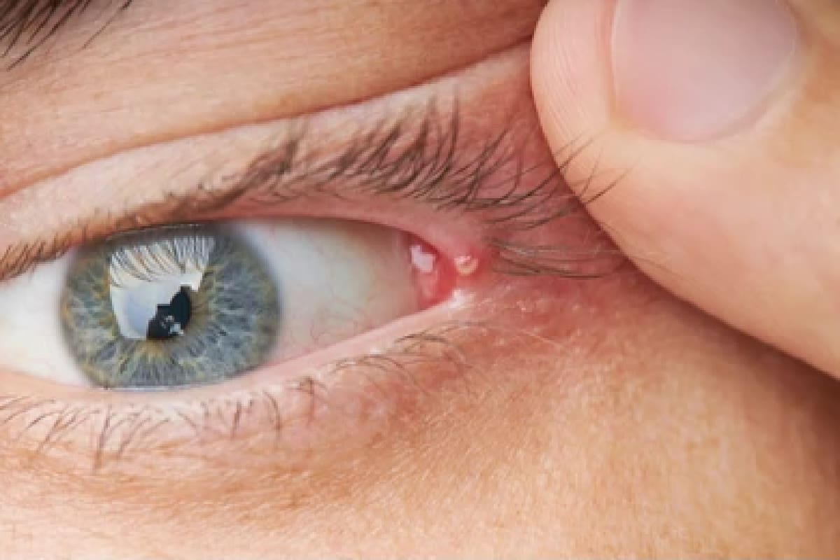 How to Get Rid of a Pimple or Bump on the Eyelid Causes & Treatment