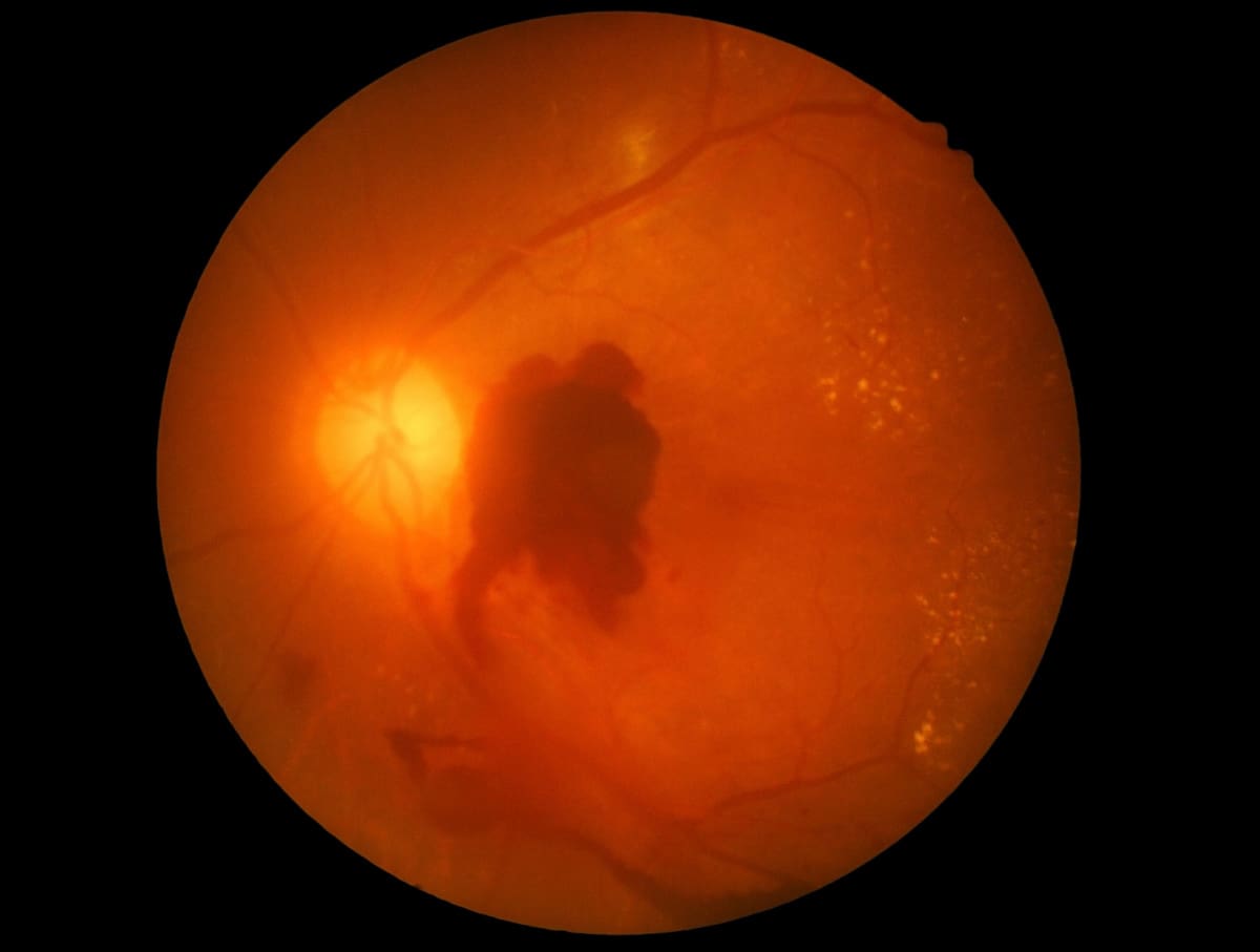 Retinal Bleeding (Retinal Hemorrhages) Types & When to See a Doctor