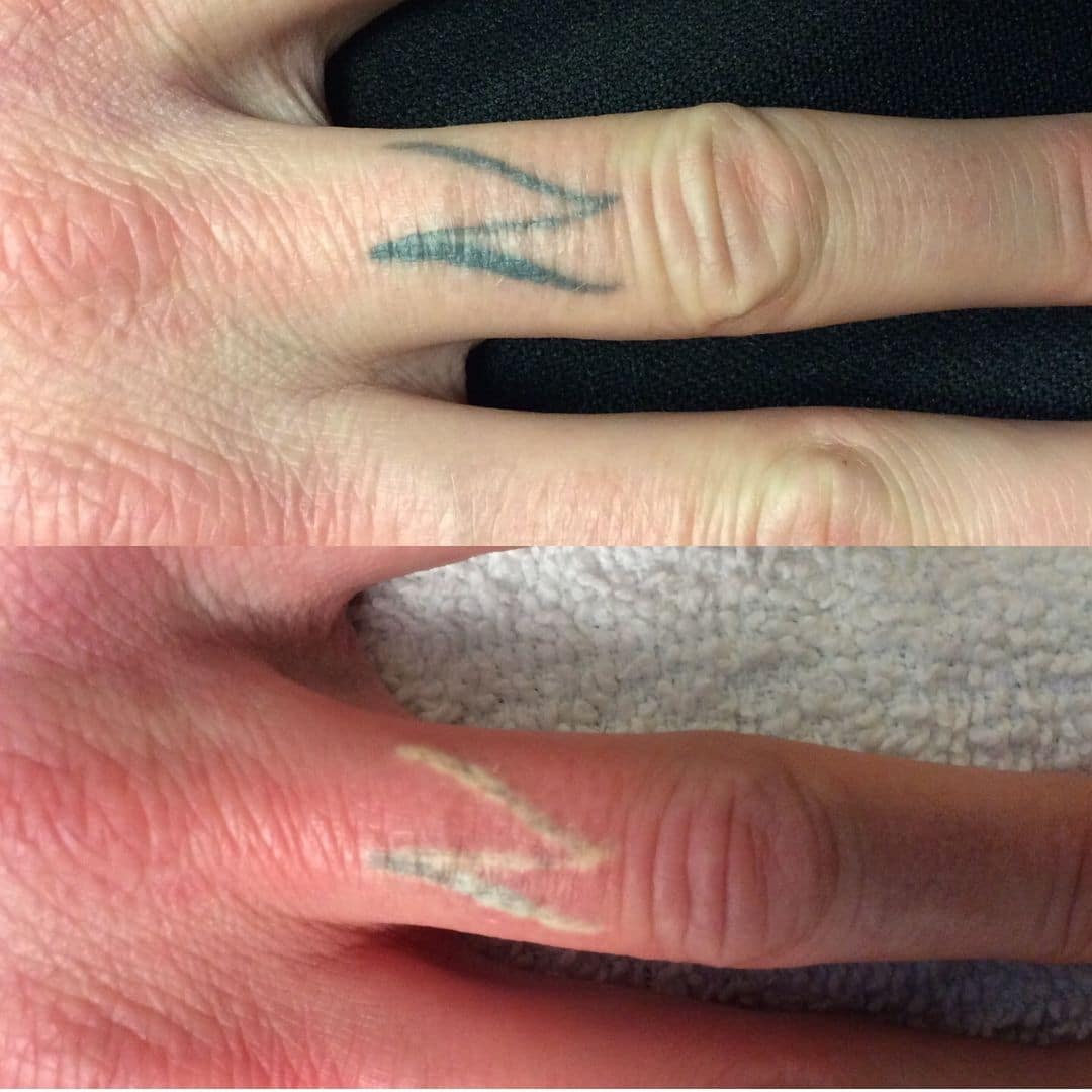 Tattoo Removal Before and After Pictures of Our Patients at VIVAA