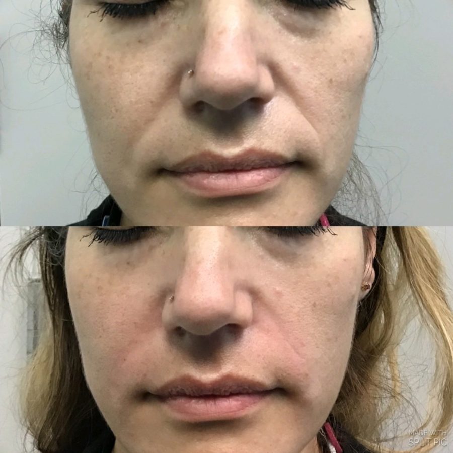 Botox and Wrinkle Before & After Pictures VIVAA in Issaquah and