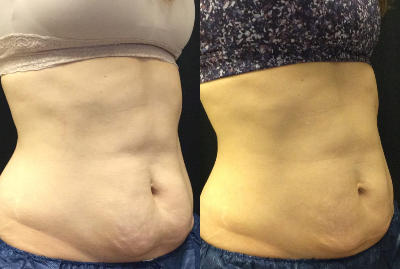 CoolSculpting vs. Cryoskin Which One is Better?