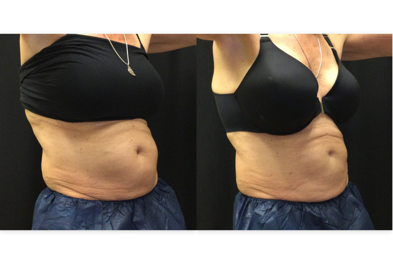 Coolsculpting Before & After Pictures VIVAA in Issaquah and Bellevue