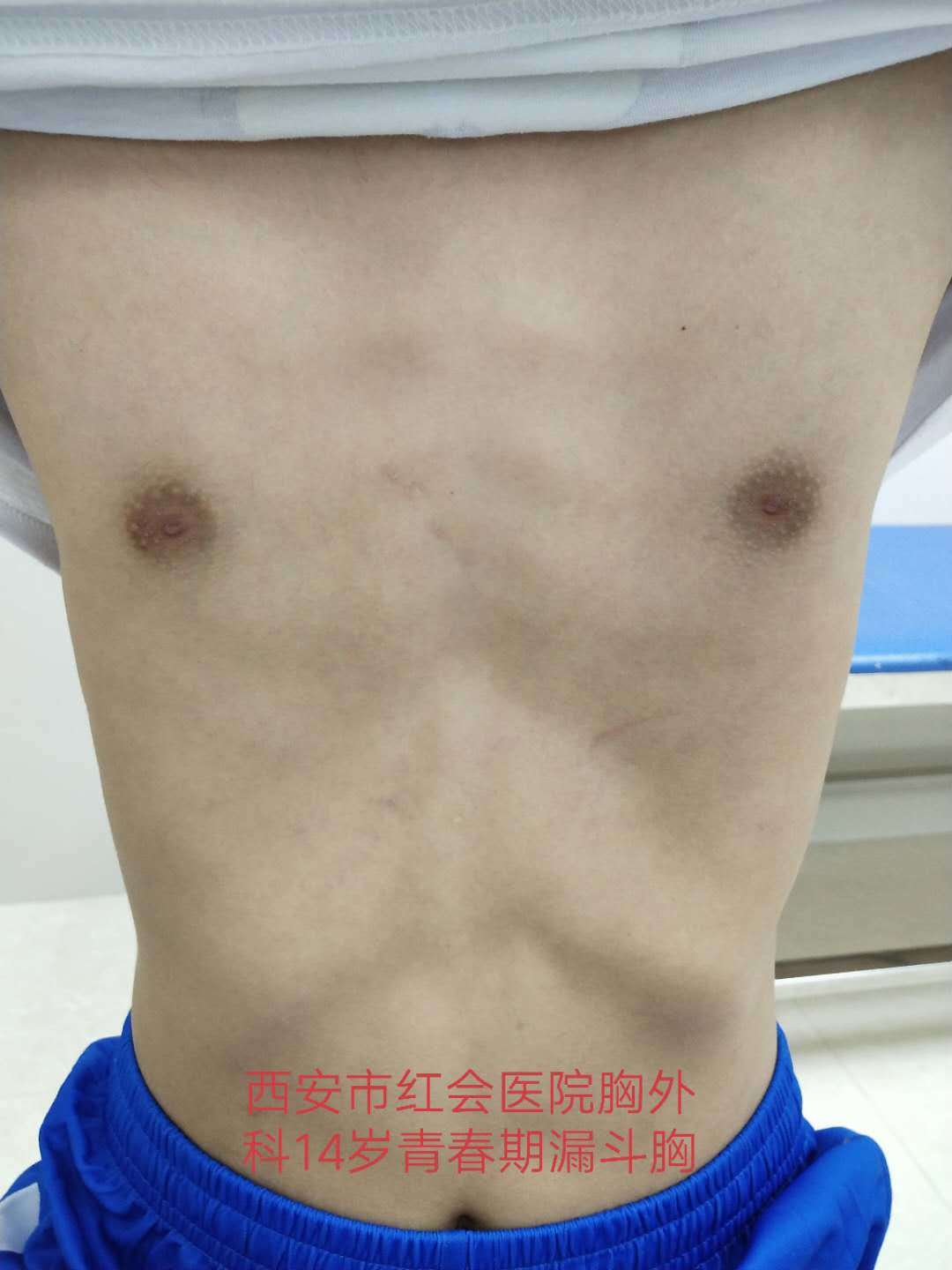 70以上 漏斗 胸 女性 画像 262649