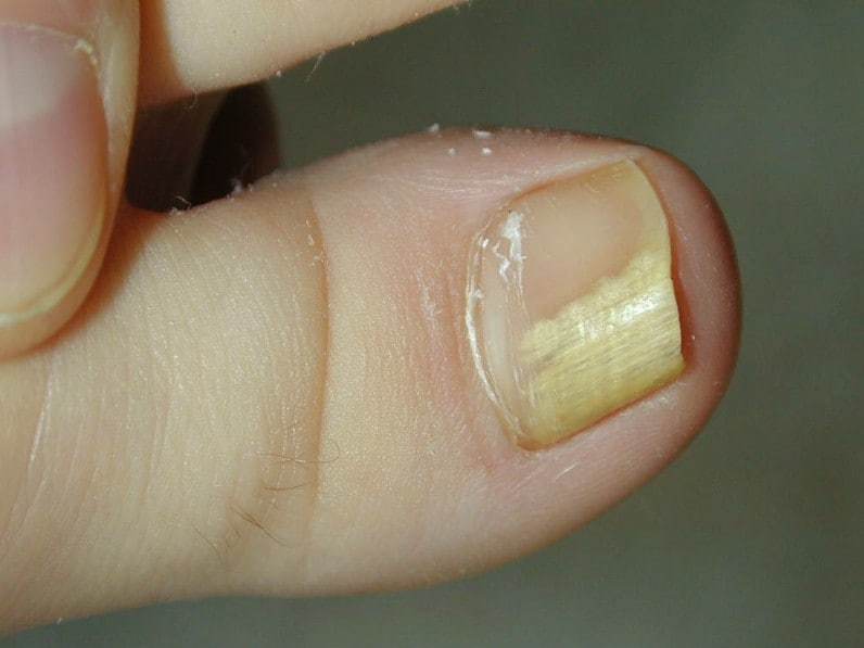 What Causes Nail Fungus On Fingernails Black Spots On Nails Causes