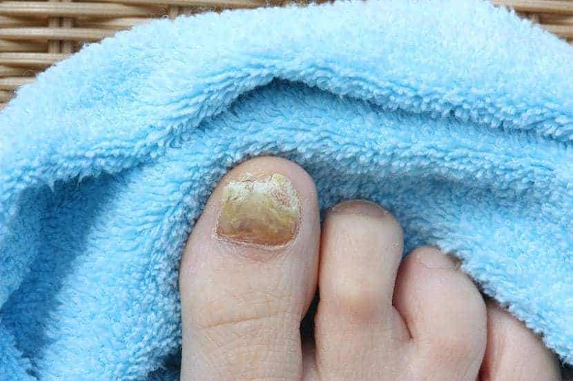 Causes of Nail Fungus 7 Bad Habit You Must Disown