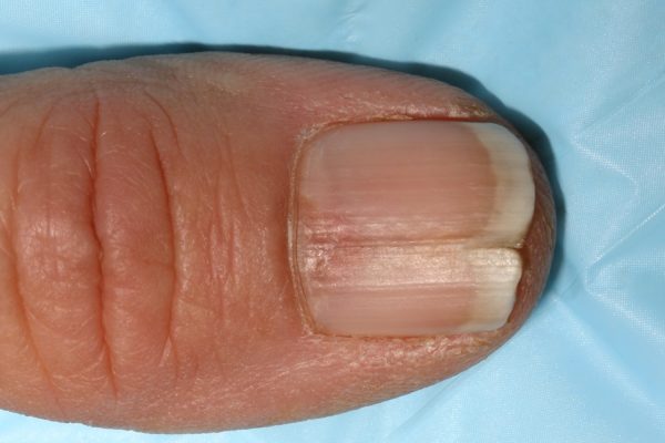 Melanonychia on Nails Symptoms, Causes & Treatment