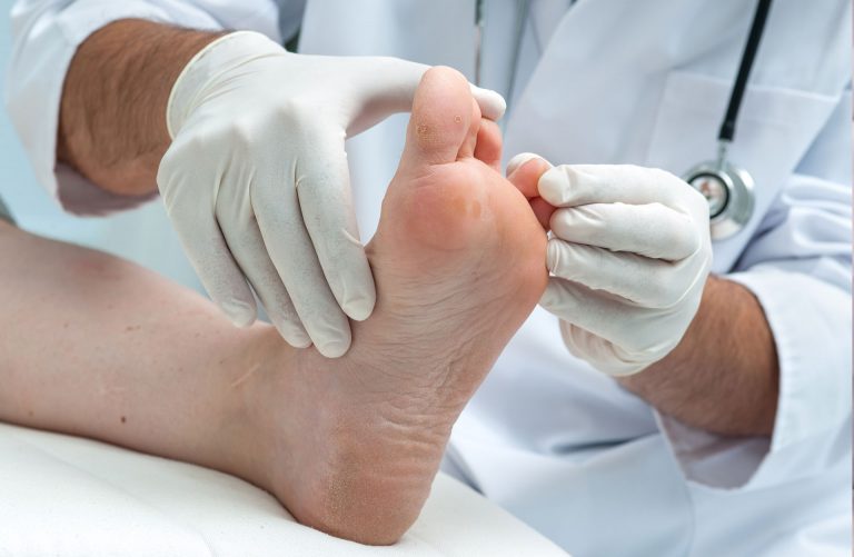 Exfoliative Keratolysis (Peeling Skin) Causes & Home Remedies