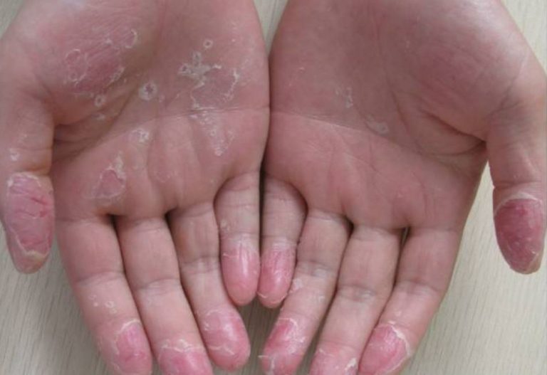 Exfoliative Keratolysis (Peeling Skin) Causes & Home Remedies