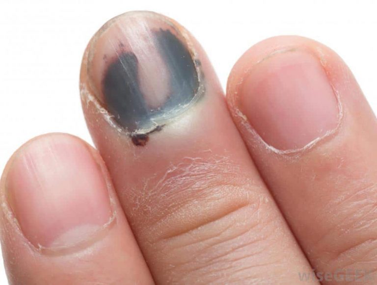 Exfoliative Keratolysis (Peeling Skin) Causes & Home Remedies