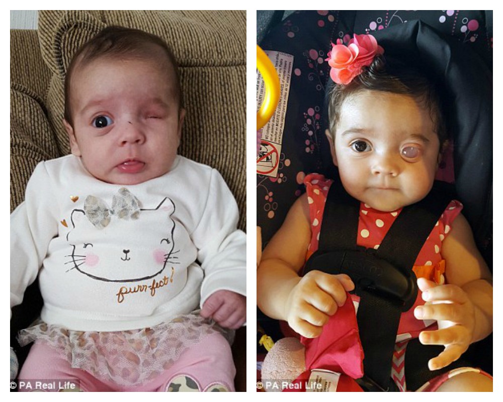 Baby Girl Born Without Eyeball Fitted With New Plastic Ball Every 2