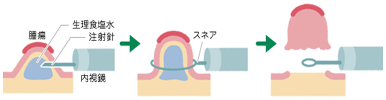 大腸ポリープ切除術の種類 【なら内視鏡クリニック】日帰り大腸ポリープ切除・楽な胃・大腸カメラ・奈良駅前